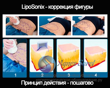 LipoSonix коррекция фигуры